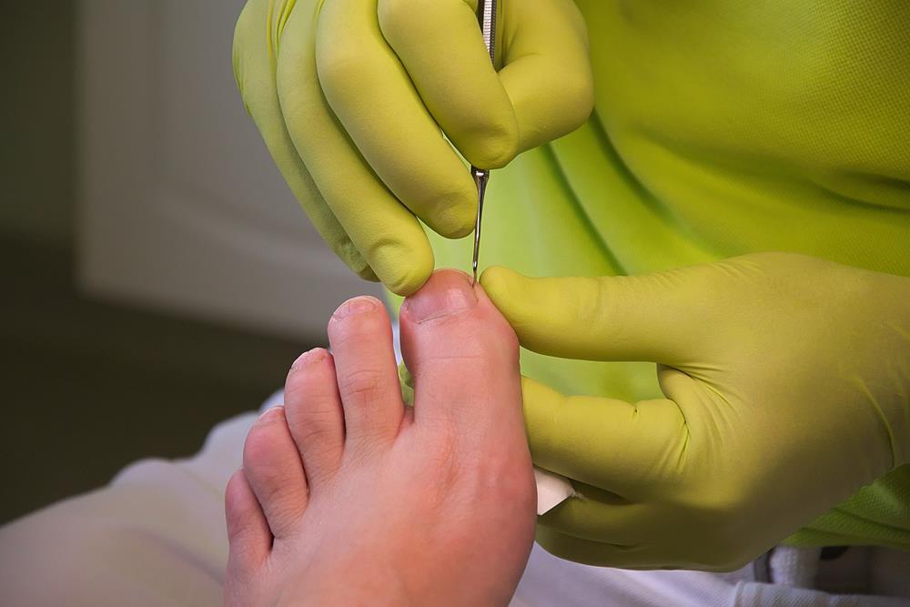 Ingrown Toenails  New Smyrna Beach, FL, 